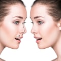 All About Rhinoplasty: Understanding the Procedure and Finding the Best Cosmetic Surgeon
