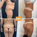 All You Need to Know About Butt Lifts