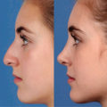 What's the difference between a plastic surgeon and a cosmetic surgeon?