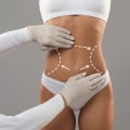 Understanding Liposuction: All You Need to Know About This Popular Cosmetic Surgery