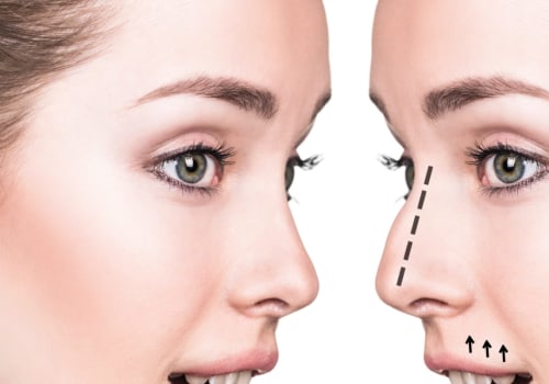 All About Rhinoplasty: Understanding the Procedure and Finding the Best Cosmetic Surgeon