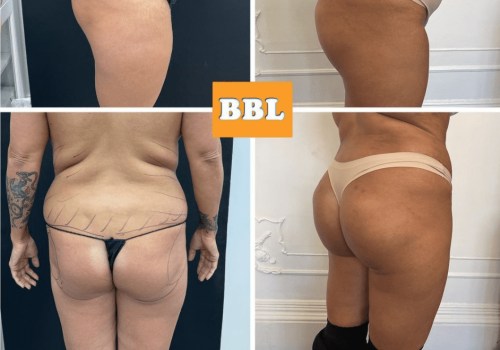 All You Need to Know About Butt Lifts