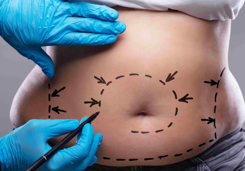 What You Need to Know About Tummy Tucks