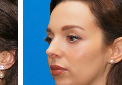 A Complete Guide to Cheek Augmentation: Everything You Need to Know
