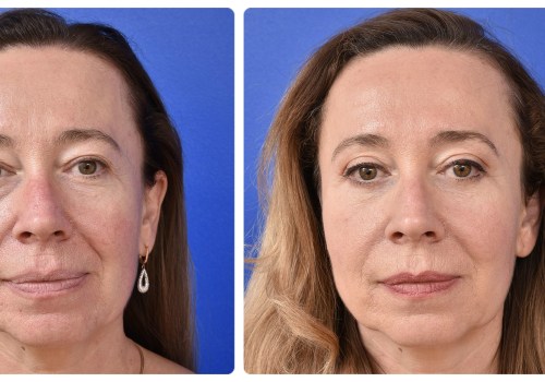 A Comprehensive Look at Brow Lift Surgery